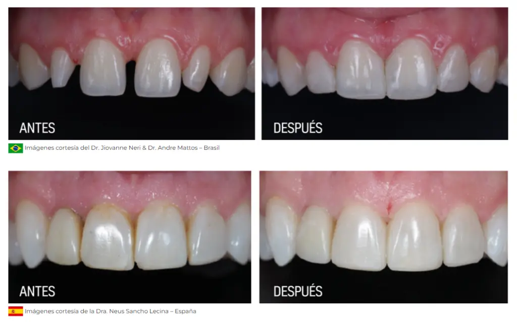 Luna 2 Composite Nanohíbrido Complet 20cap de 0,25g SDI.webp