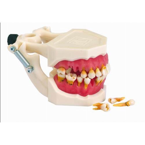 [z9607] Modelo de parodontopatias