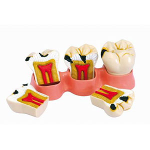[z9608] Modelo estados de la caries